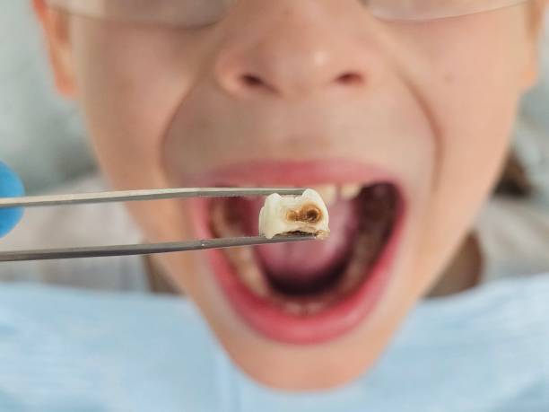Best Emergency Wisdom Tooth Extraction in Decatur, MS